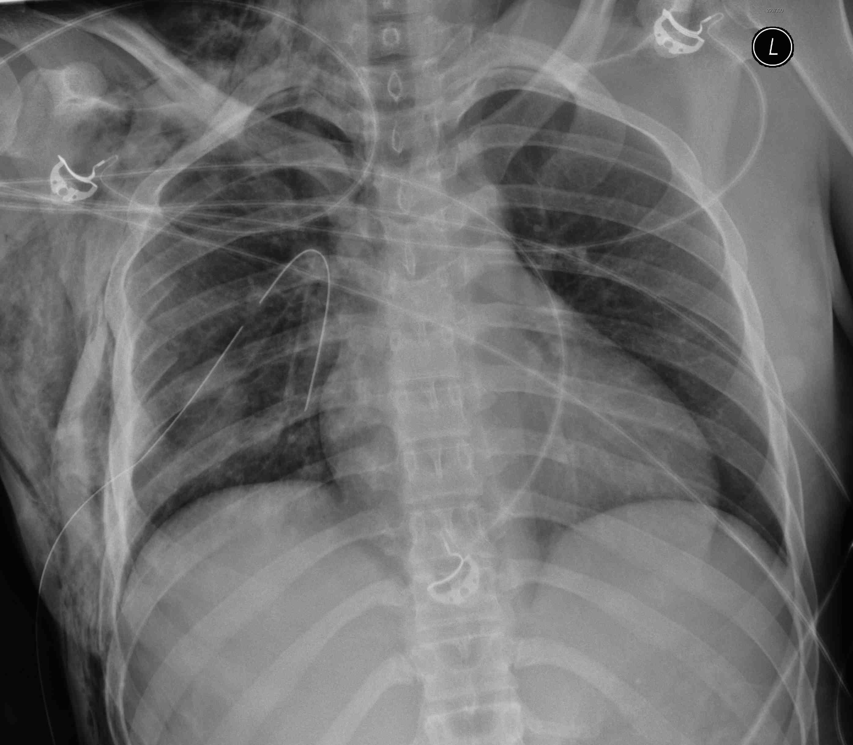 Pneumothorax Post ICC